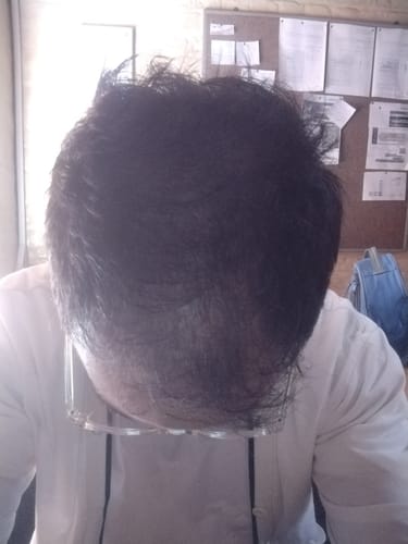 Customer photo review of Minoxidil High Strength (5%) SOLUTION, 3x60ml pack