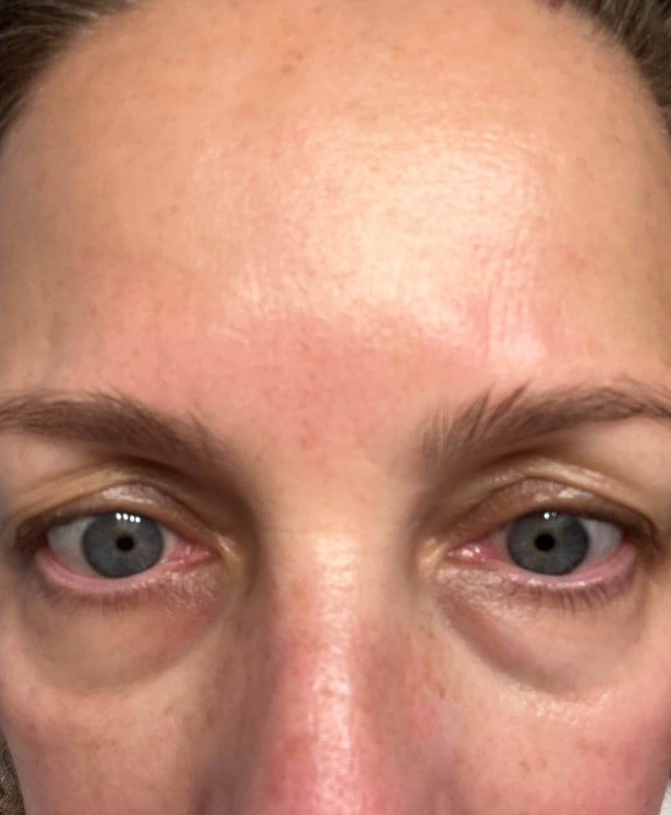 Customer photo review of Dr.Pen Derma Stamp Bio Needle 120