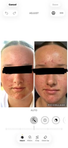 A customer's before-and-after photo of their face, showing a visible reduction in redness and acne after using Pimple Pals.