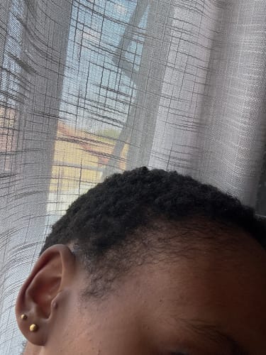 Customer photo review of Minoxidil REGULAR (2%) strength SOLUTION, 3x60ml pack