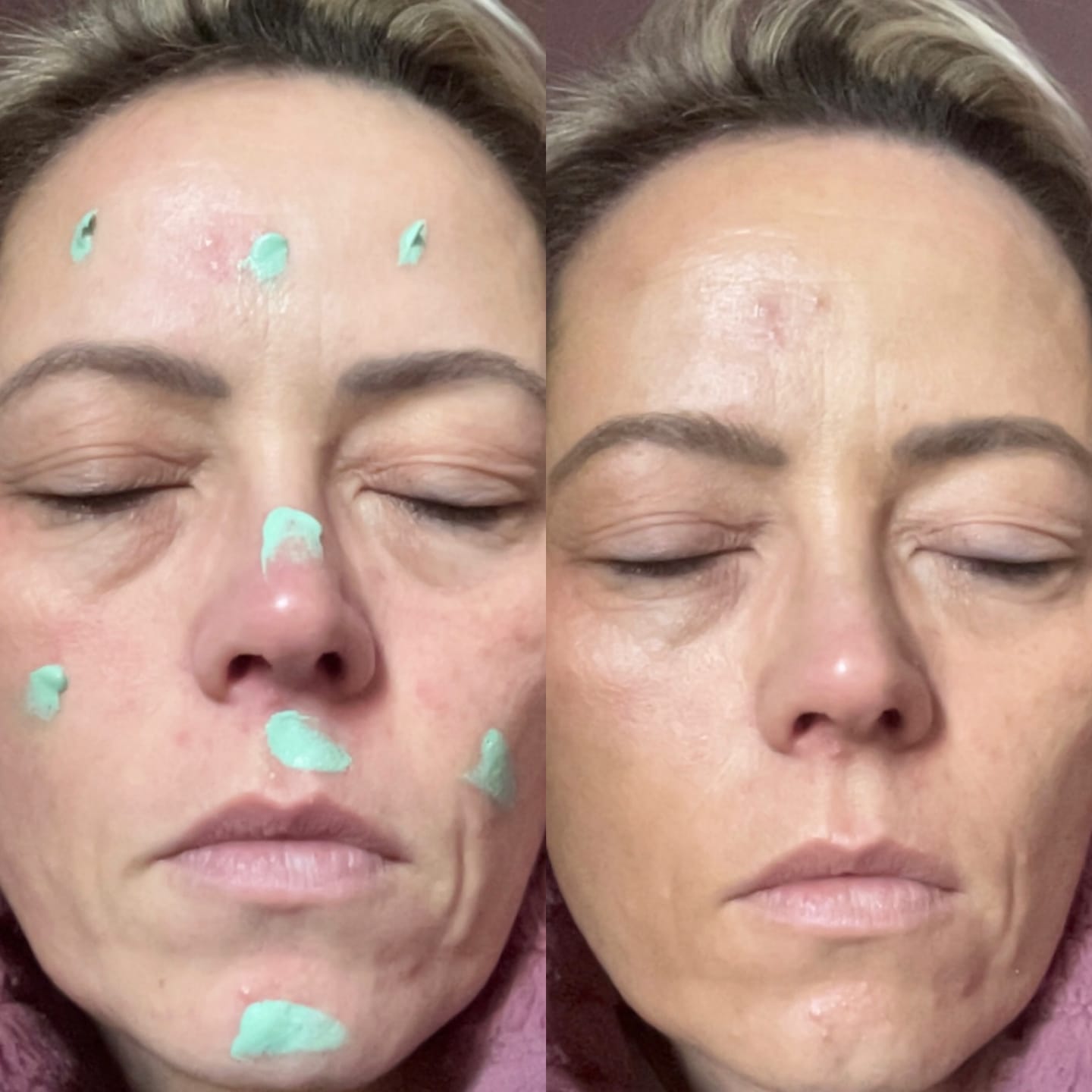 Customer photo review of Rosalique 3 in 1 Anti-Redness Miracle Formula SPF50