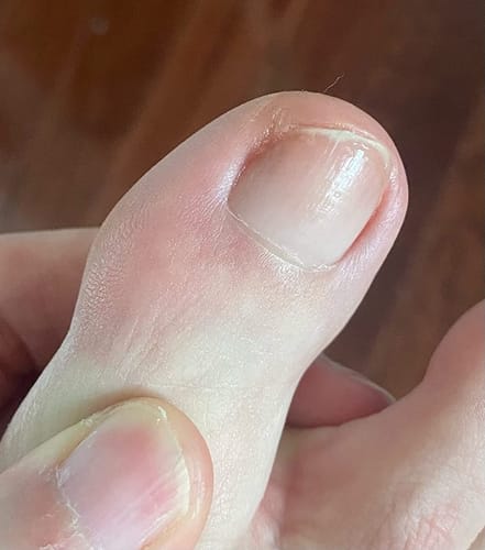 Customer photo review of MyCurePro® Penna Antifungina con Formula Avanzata – Contro il Piede d’Atleta e i Funghi delle Unghie