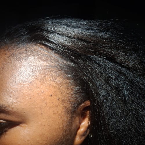 Customer photo review of Minoxidil High Strength (5%) SOLUTION, 3x60ml pack