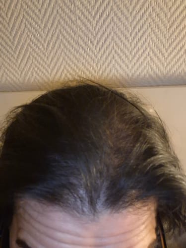 Client montrant une zone de cheveux clairsemés sur le dessus de sa tête.