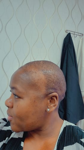 Customer photo review of Minoxidil High Strength (5%) SOLUTION, 3x60ml pack