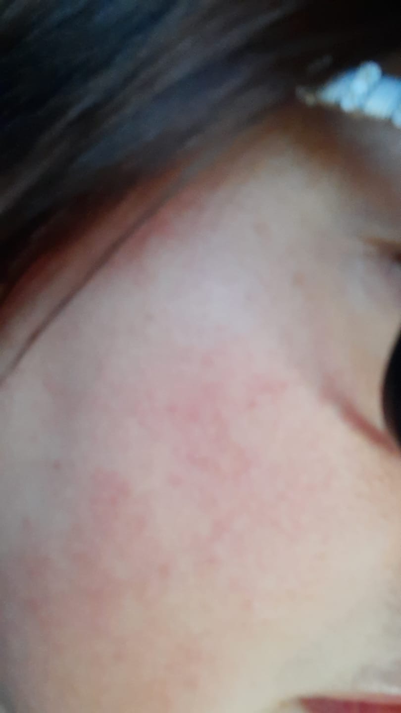 Customer photo review of Rosalique 3 in 1 Anti-Redness Miracle Formula SPF50