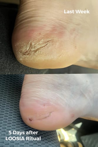 Customer photo review of MyCurePro® Reparador de Pies y Talones en Barra