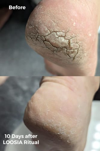 Customer photo review of MyCurePro® Reparador de Pies y Talones en Barra