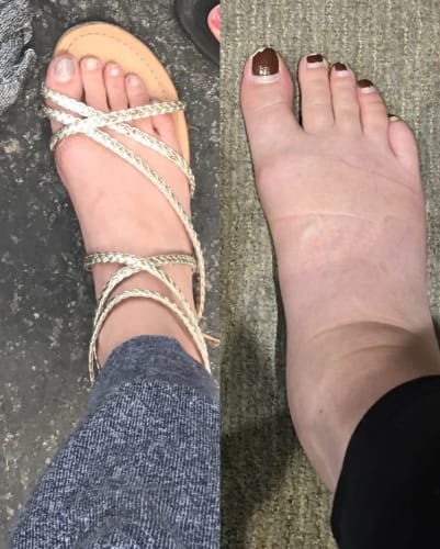 Customer photo review of Medias de Compresión Lumilegs™ Premium