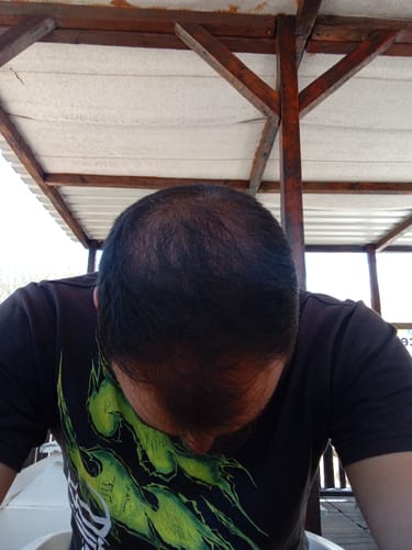 Customer photo review of Minoxidil DOUBLE ACTION FOAM, MEN ONLY 3x60ml Pack