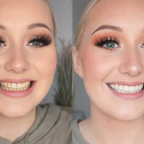Customer photo review of Branqueador dental V34