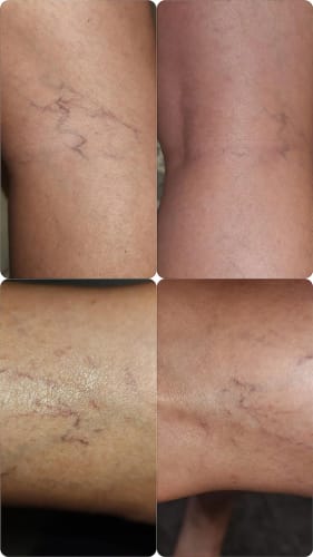 Customer photo review of Medias de Compresión Lumilegs™ Premium