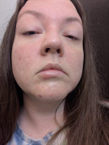 Reviewer's face showing acne and redness before using the Grass Fed Tallow & Honey Balm.