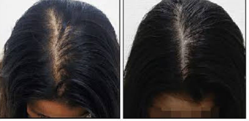 Customer photo review of 32 Day Hair Growth Challenge Bundle