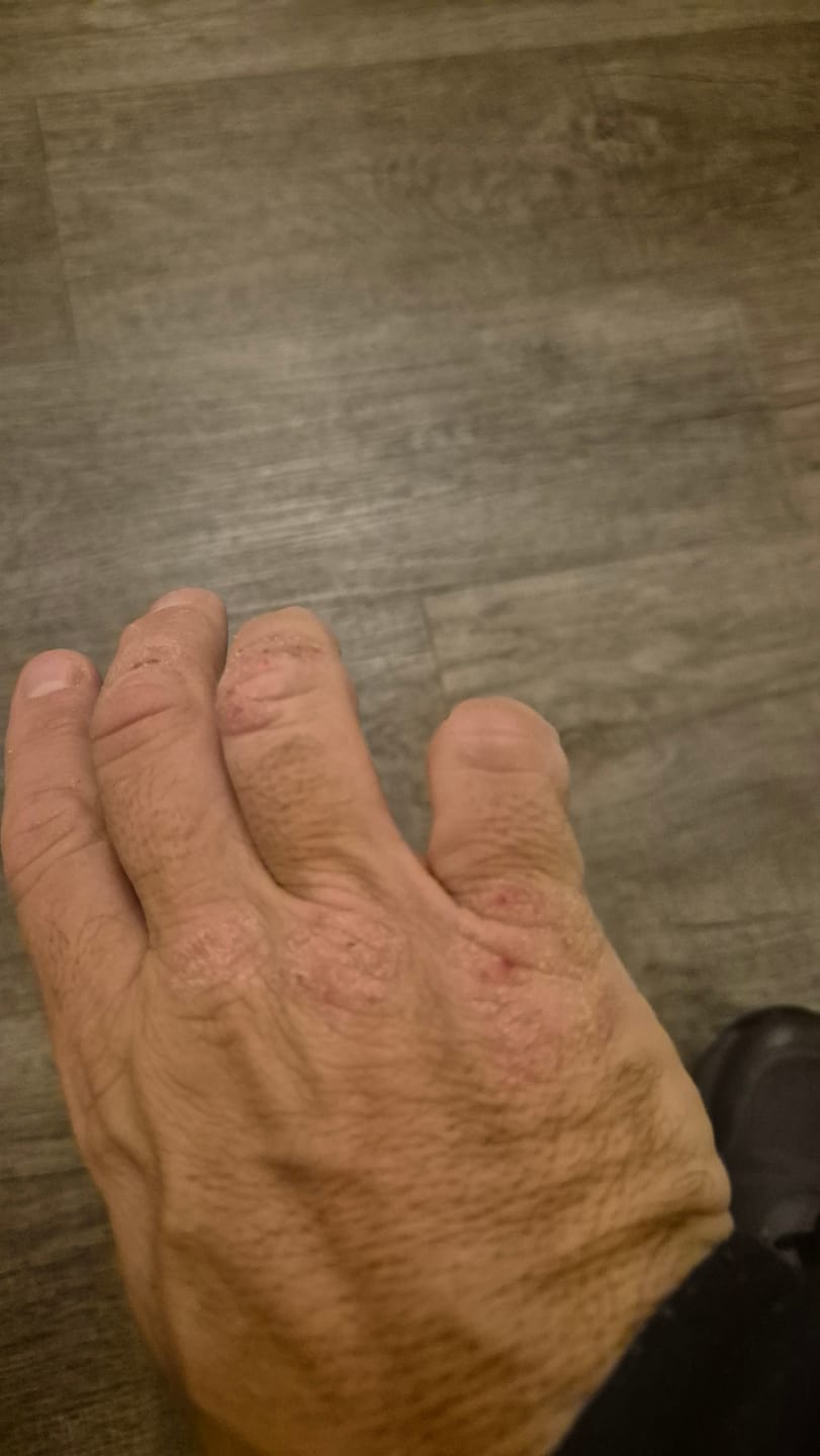 Customer photo review of Bioskin Duo Pack