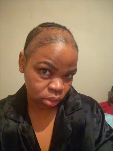 Customer photo review of Minoxidil High Strength (5%) SOLUTION, 3x60ml pack