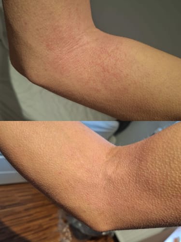 Customer photo review of Eczema Scratch Mitten