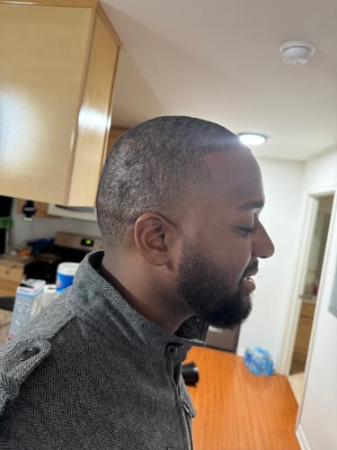 Customer's profile view showing a short haircut with some thinning visible at the temple line before results.