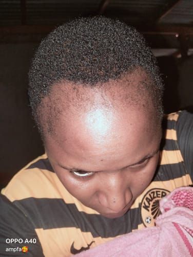 Customer photo review of Minoxidil High Strength (5%) SOLUTION, 3x60ml pack