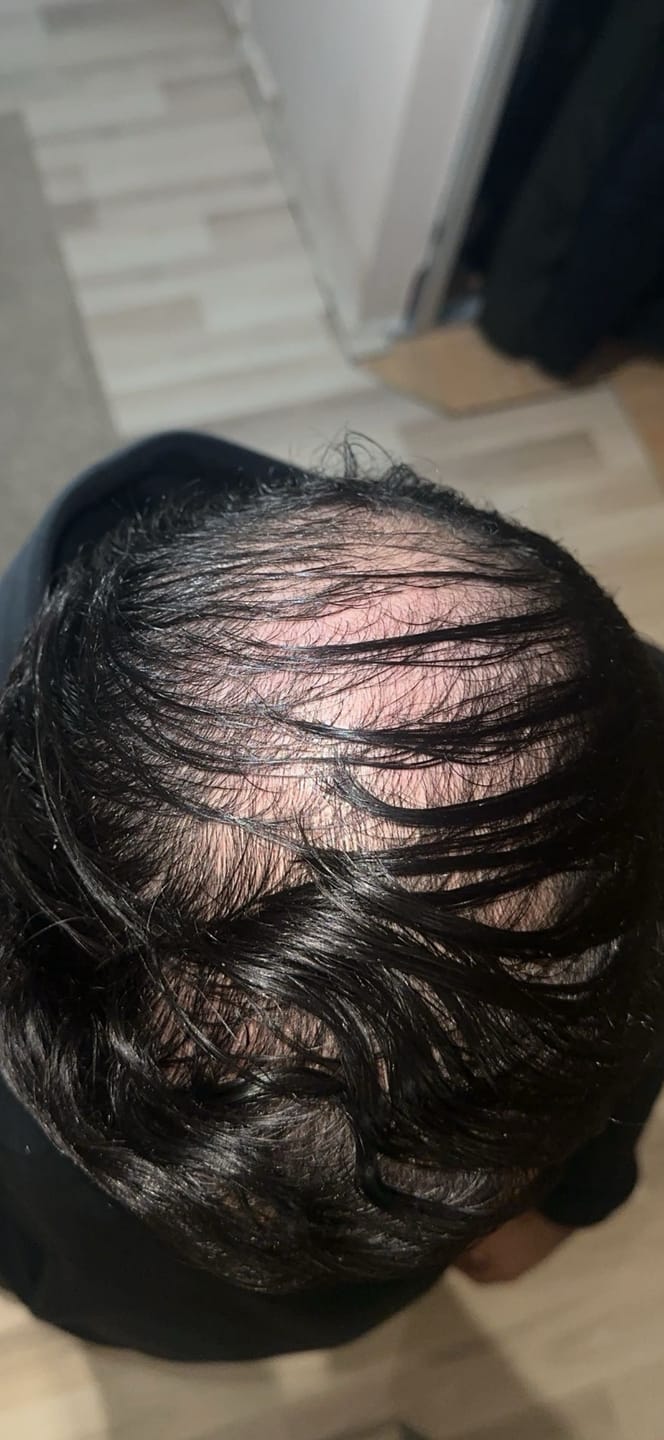 Customer photo review of SÉRUM CAPILLAIRE MULTI ACTIF BIO-DENSYL®