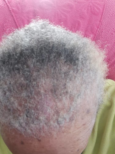 Close-up of a reviewer's scalp showing new hair growth in a thinning area after using Rennora Hair Growth Serum.