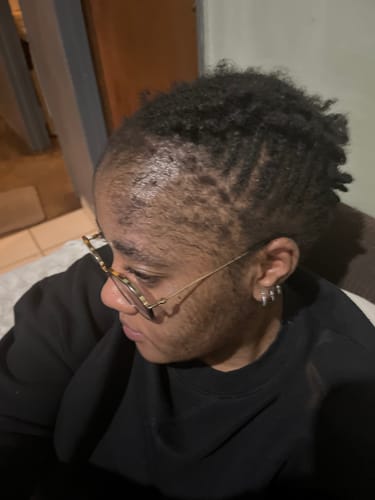 Customer photo review of Minoxidil High Strength (5%) FOAM, 3x60ml pack