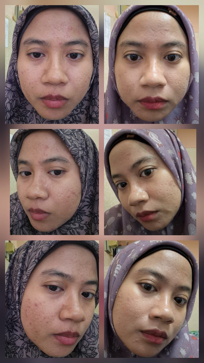 Customer photo review of Renewal: Triple Action Serum [Limited Edition]