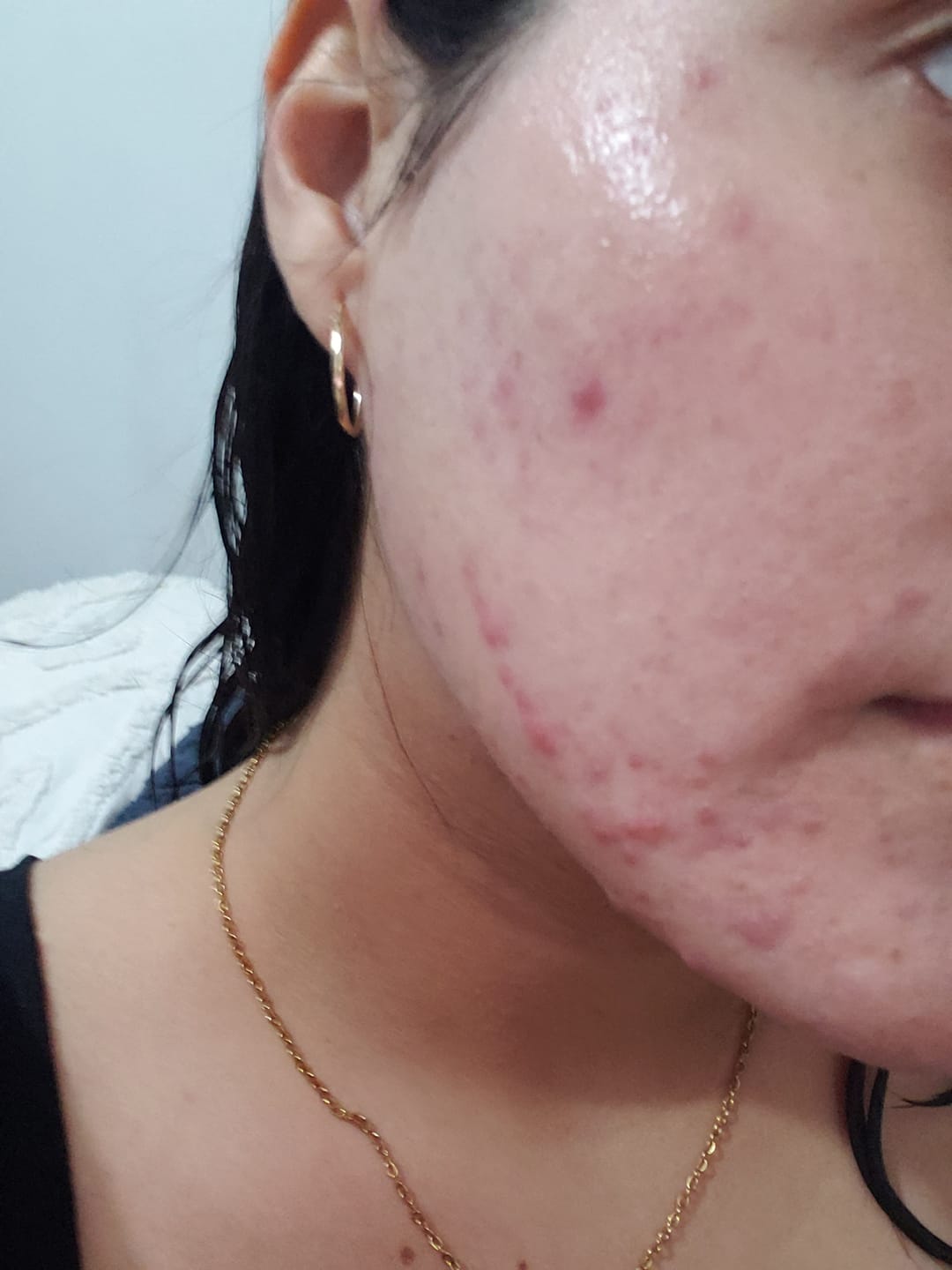 Customer photo review of ANUA - Niacinamide 10% + TXA 4% Serum 30 ML | Suero Antimanchas