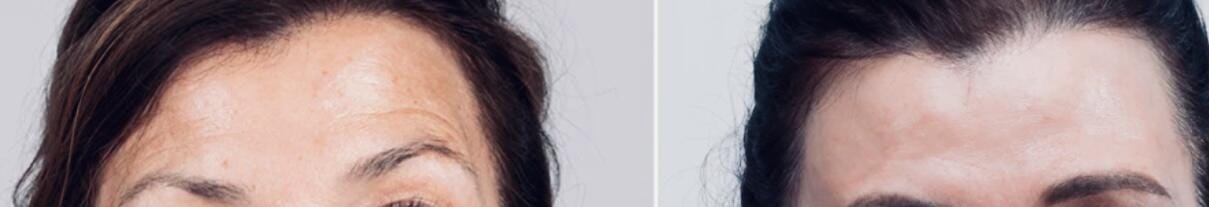 Customer photo review of Hyaluron Augengel Roll On