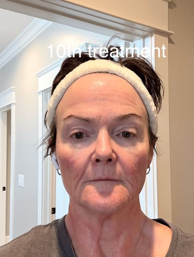 Reviewer's face after their 10th treatment with the Micro Infusion System, showing clearer skin.