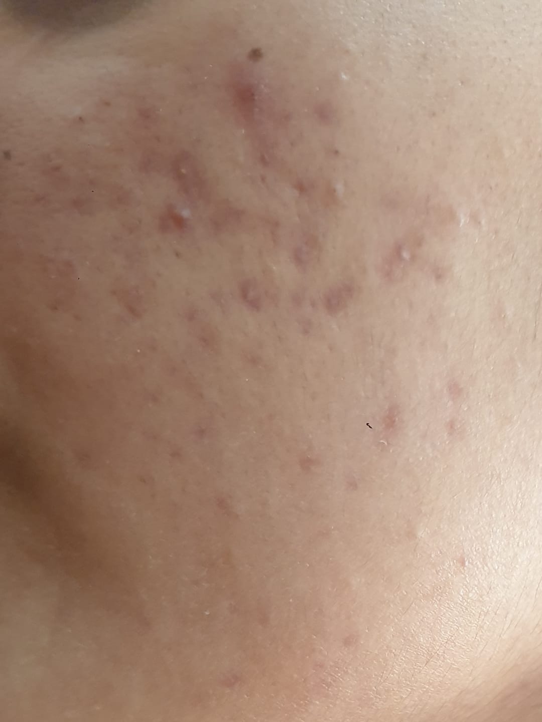 Customer photo review of MandelAC Serum