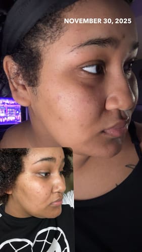Customer shares a before-and-after image of their face, showing reduced dark spots after using the Melanin Skin Bundle.