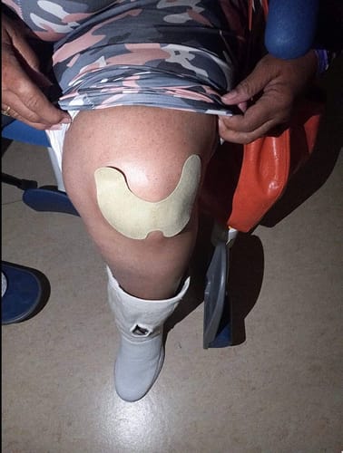 Customer photo review of Parches Naturales para Dolor de Rodillas Aliviate™