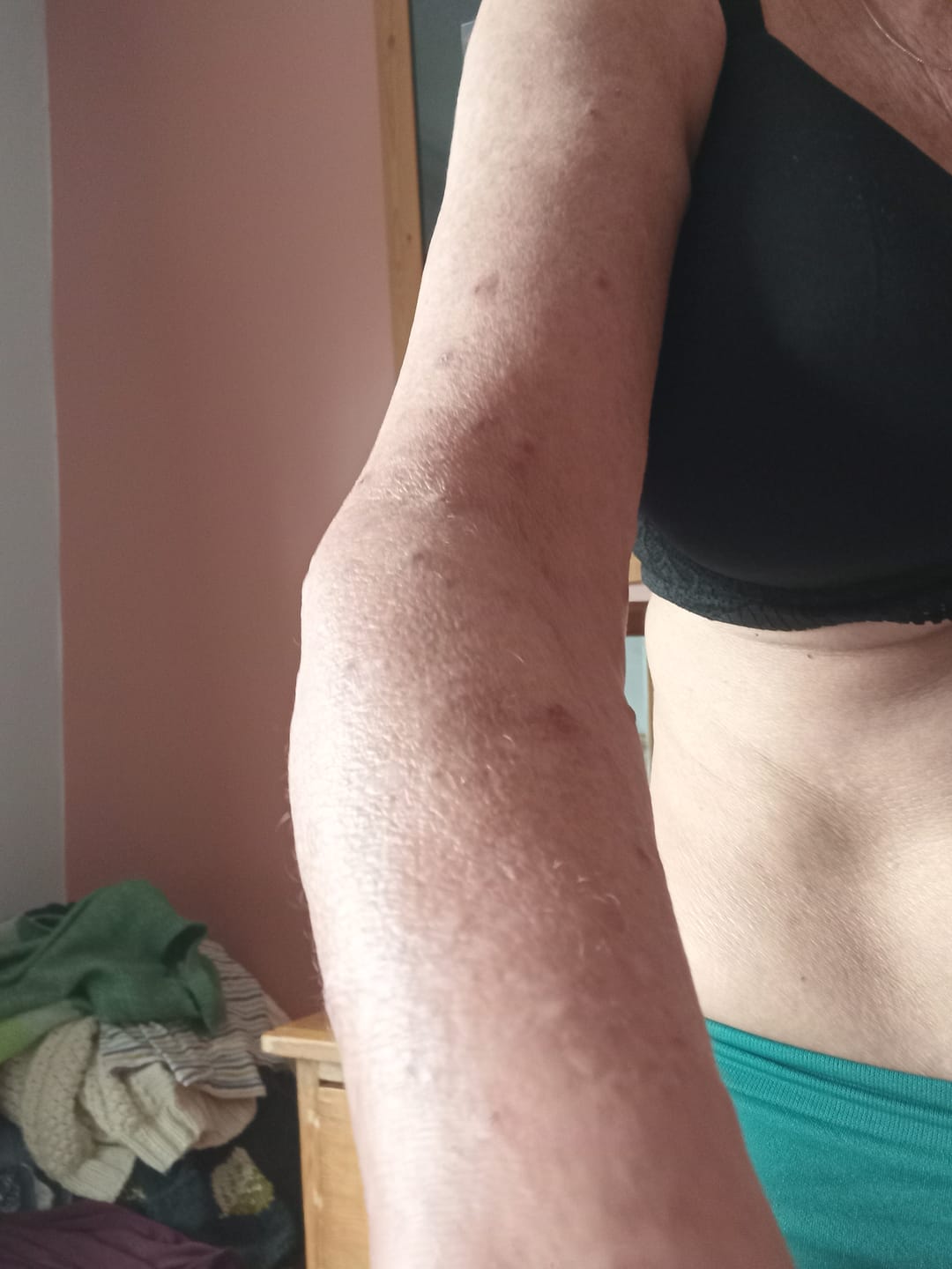 Customer photo review of Bioskin Zeoderm Skin Repair Moisturiser