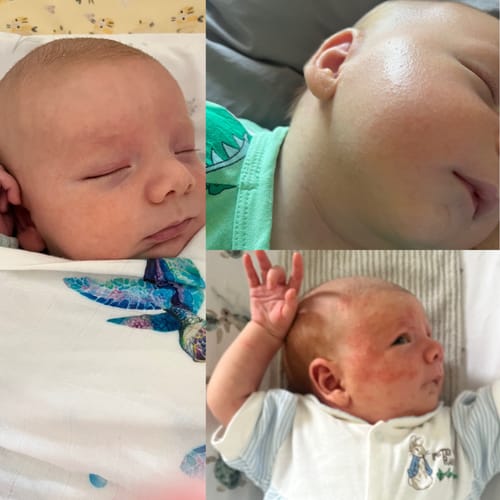 Customer's collage showing a baby's heat rash before and clear skin after using Manuka Moisturising Baby Butter.
