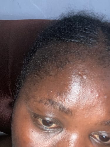 Customer photo review of Minoxidil High Strength (5%) SOLUTION, 3x60ml pack