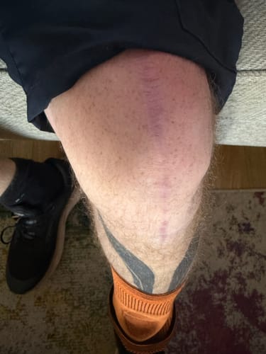 Customer photo review of Knee Compression Support Sleeve For Arthritic Relief & Pain Recovery