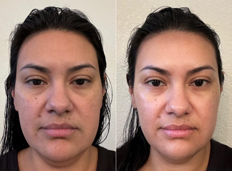 Customer photo review of INIA FLARE Microcurrent Facial Device