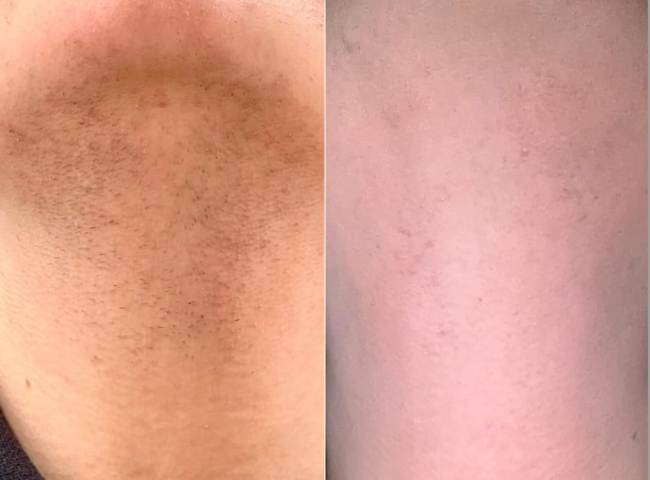 Customer photo review of INIA HAUTE Pro IPL Hair Removal Device
