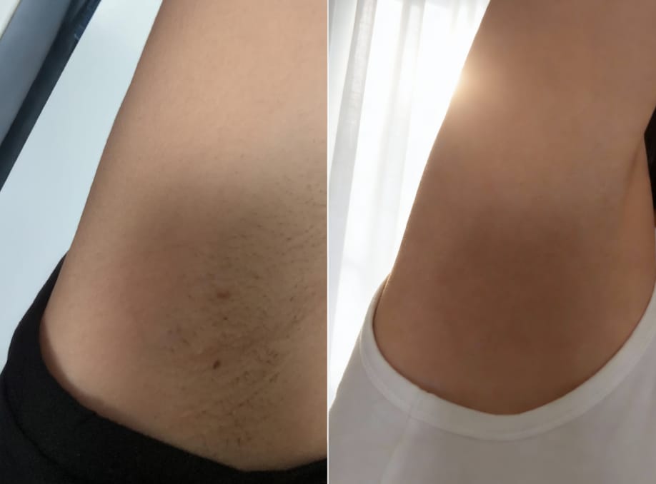 Customer photo review of INIA HAUTE Pro IPL Hair Removal Device