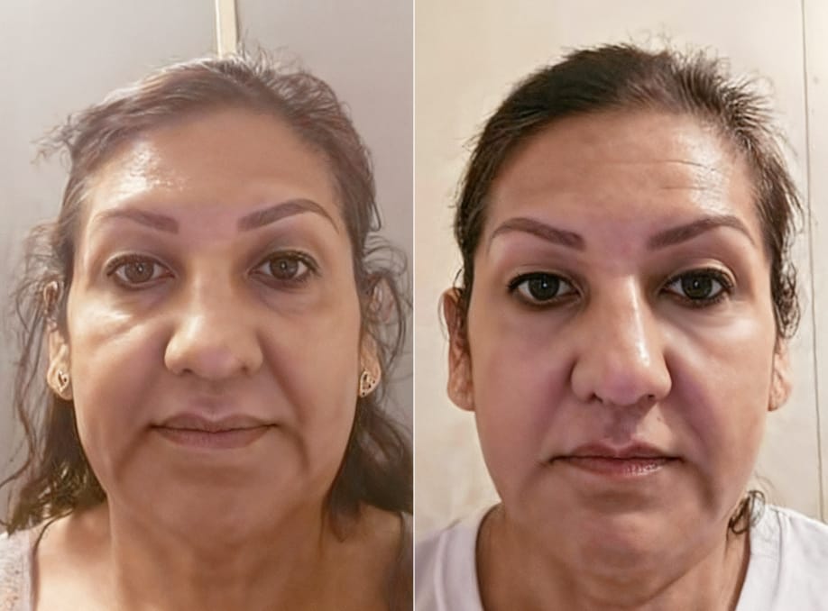 Customer photo review of INIA LUMIN Eye Skincare Device