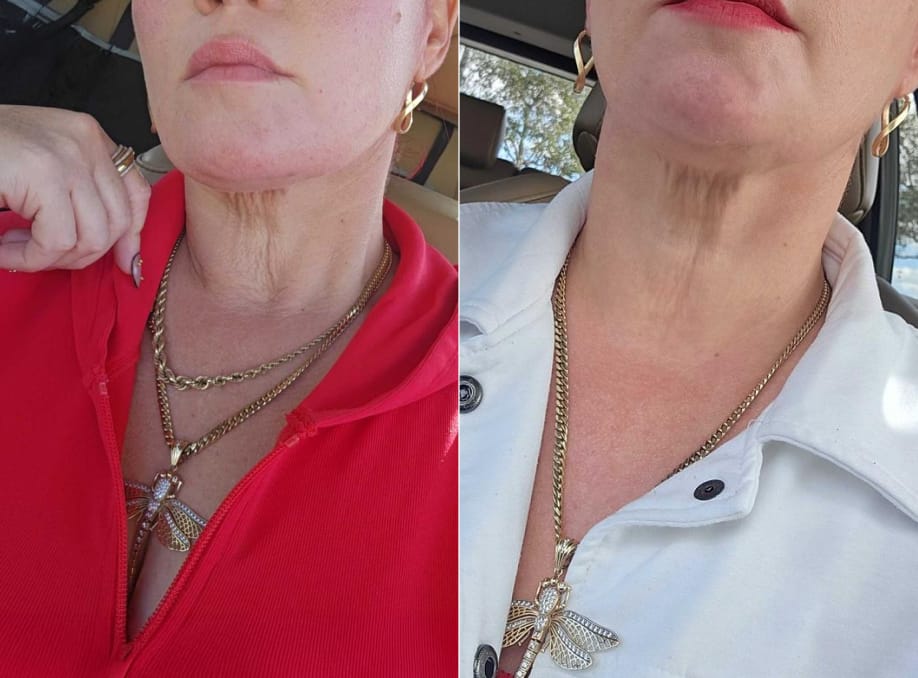 Customer photo review of INIA GLACE 7-in-1 Microcurrent Gua Sha Facial Device