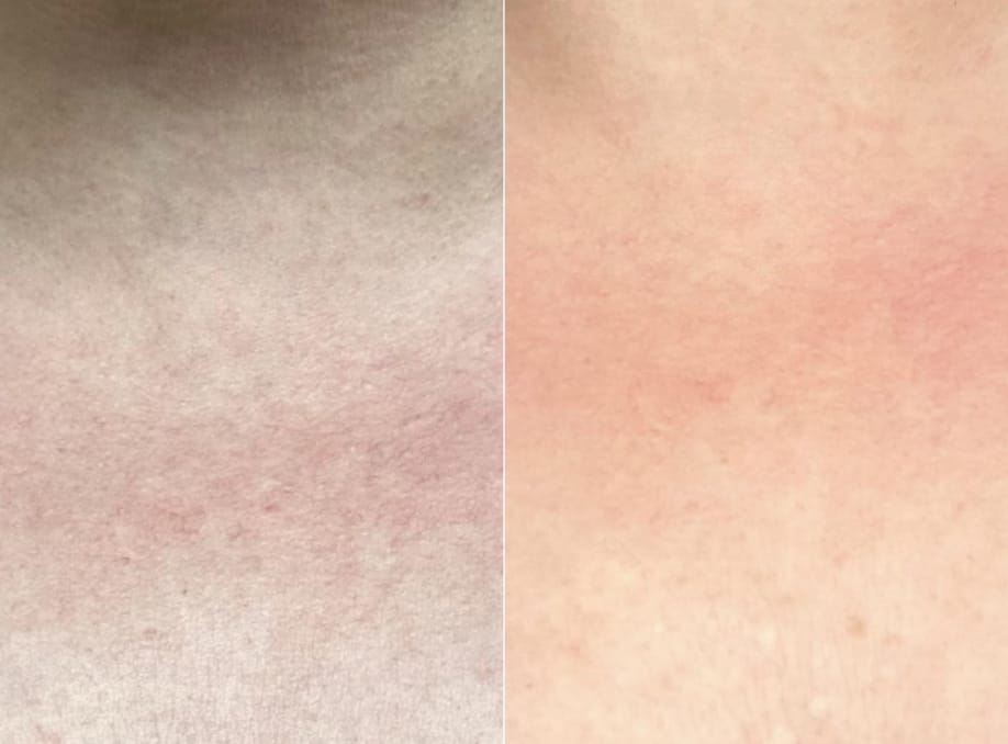 Customer photo review of INIA GLOW Neck & Chest Red Light Therapy