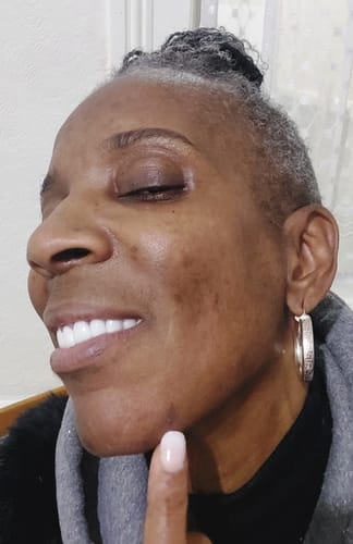 Close-up of a reviewer's face, showing how marks have lightened after using Ava+ Membership products.