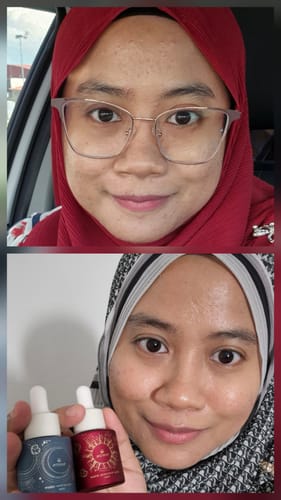 Customer's before-and-after image. The after photo shows her holding the Gold Radiance Serum with clearer, brighter skin.