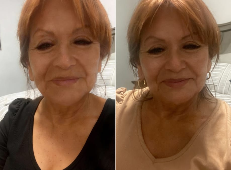 Customer photo review of INIA GLOW Neck & Chest Red Light Therapy