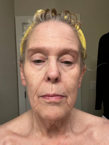 Customer's face in a close-up photo, showing their skin before using the Micro Infusion System.