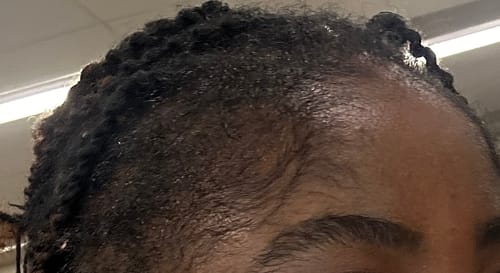 Customer photo review of NOVIFUL Hair Growth Serum - 1 PACK