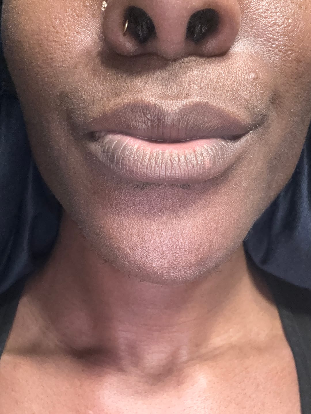 Customer photo review of Lips Lightening Cream For Men and Women (Results in 5 Days or Less)