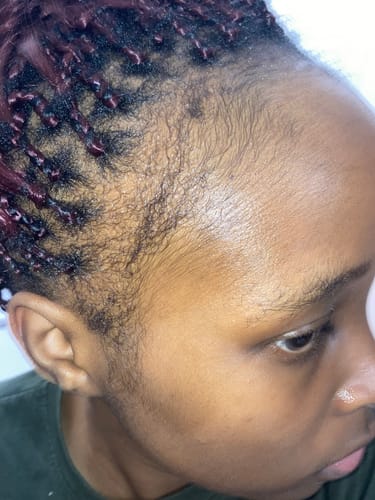 Customer photo review of Minoxidil REGULAR (2%) strength SOLUTION, 3x60ml pack